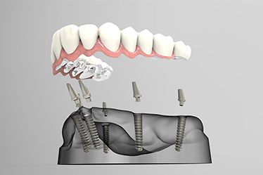 How Painful are Dental Implants Procedure? When carried out by experienced Dentists