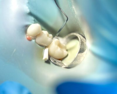 Wisdom Teeth: Myths, Facts, and When to Consider Removal